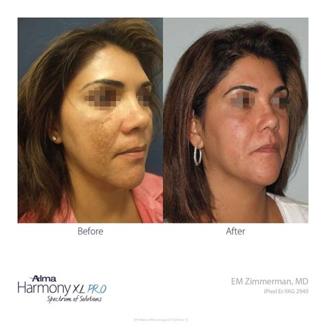 Pixel Erbium laser Skin Resurfacing - MIYA Aesthetics & Wellness