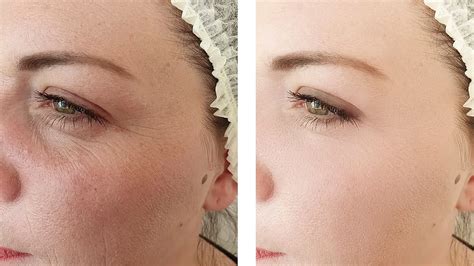 Thread Lift vs. Botox: Navigating the World of Anti-Aging procedures
