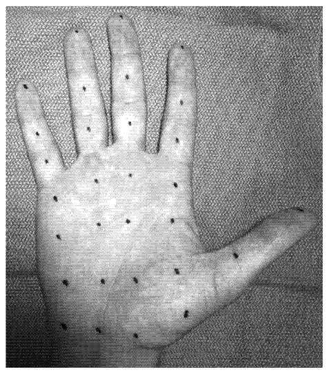 Hyperhidrosis: Anatomy, Pathophysiology and Treatment with Emphasis on ...