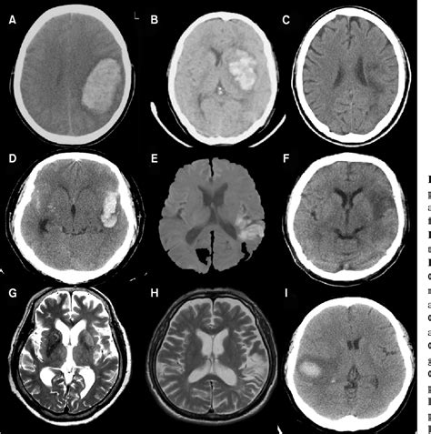 Image result for Conduction Aphasia