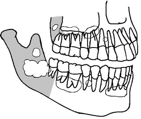 Odontogenic Keratocyst