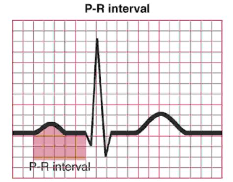 Image result for PR Interval Normal Range
