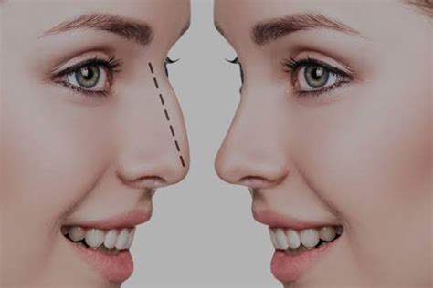 NAKSH RHINOPLASTY CENTER