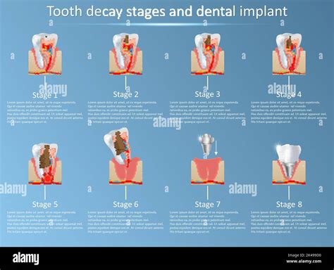 Tooth decay stages and dental implant. Vector illustration. Dental medicine and replacement ...