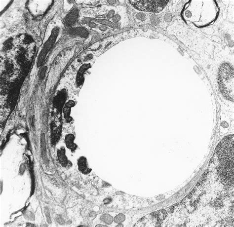 Multiple Rickettsia tsutsugamushi Free within Brain Capillary ...