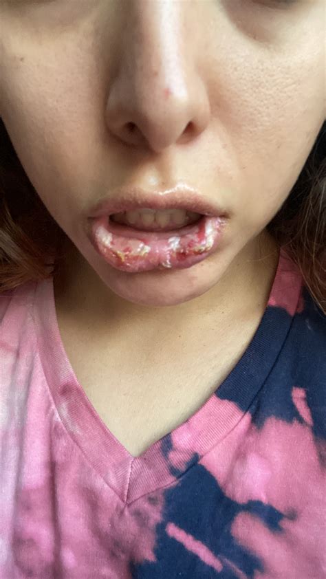 I got a 'free' popsicle and suffered horrific lip burns