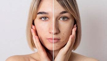 How to Get Rid of Ice Pick Scars: Best Remedies & Treatments – Chicnutrix