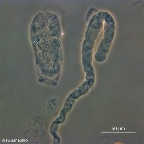 Urine Microscopy with Dr. Florian Buchkremer – GlomCon (pubs)