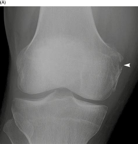 Medial Femoral Condyle Fracture