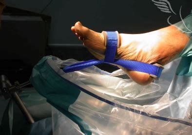 Ankle Arthroscopy - The Foot and Ankle Clinic