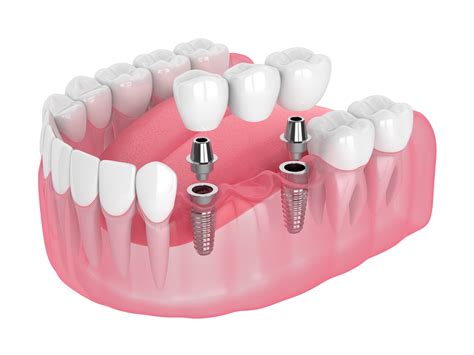 Dental Implant Bridges In New Port Richey | Dental Implant Bridges Near You