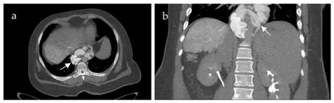 Spleno-Mesenteric Venous Blood Flow Dynamics in Adult Patients with ...