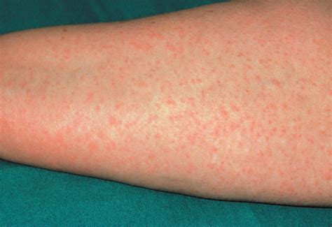 Penicillin allergy: identification and management - The Pharmaceutical ...