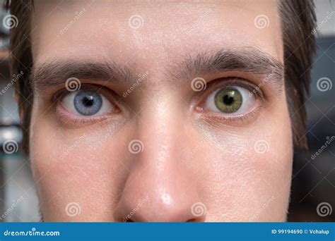 Kids With Two Different Colored Eyes / Mehmet and kerem selman, aged 11 and four, each have a ...