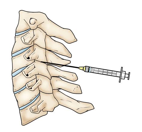 Spinal Injections - OrthoInfo - AAOS