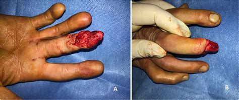 Treatment of finger degloving injury with acellular dermal matrices: Functional and aesthetic ...