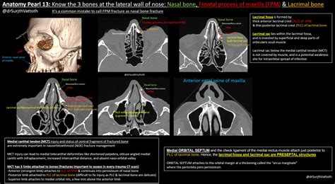 Nasal Bone Xray Midface Diagnosis Nasal/NOE, Nasal Bone AO