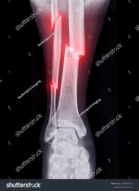 X Rays Of Broken Ankles 198 Broken Ankle X Ray Stock Photos, High Res
