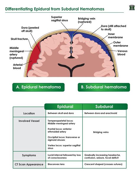 Epidural Hematoma Vs Subdural Hematoma