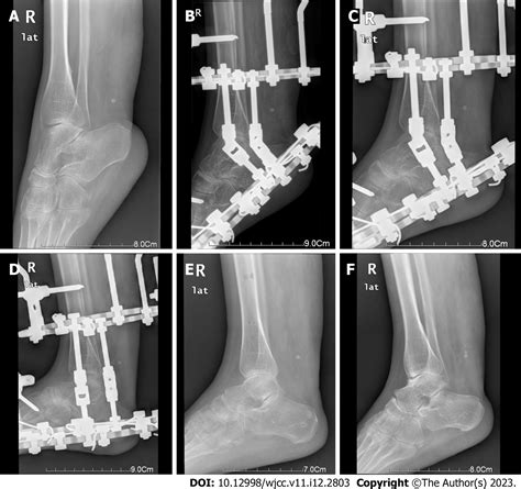 Treatment of talipes equinovarus after triceps surae intramuscular hemangioma surgery by ...