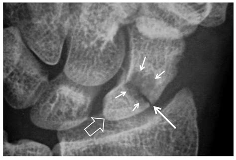 Scaphoid Shaped Abdomen