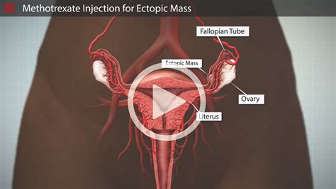 Methotrexate Injection For Ectopic Pregnancy