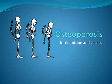 Definition & causes of Osteoporosis | PPTX