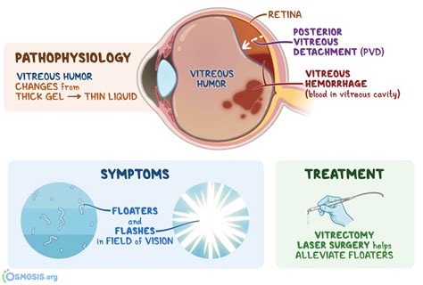 Vitreous Degeneration: What Is It, Causes, Severity, Treatment, and ...