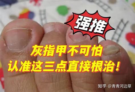 得了灰指甲怎么治？这几个治疗办法效果好，不复发，赶紧学学！