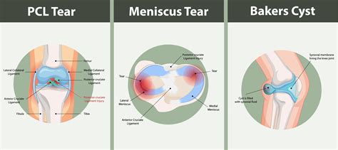 Causes and Treatments for Pain Behind Knee - Dr. Eric Giang