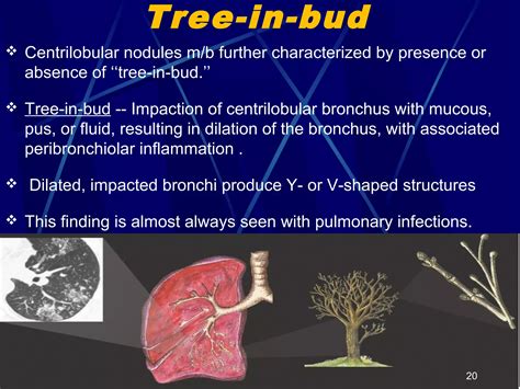 HRCT Nodular pattern | PPT