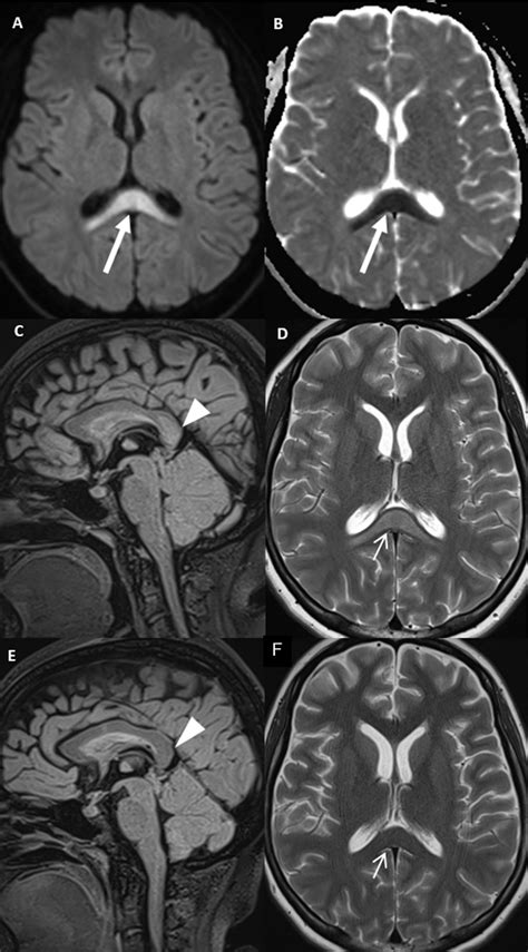 Unusual Lesion in the Splenium of the Corpus Callosum and COVID-19 Infection: A Case Report ...