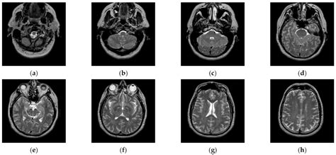 An Interval Iteration Based Multilevel Thresholding Algorithm for Brain ...