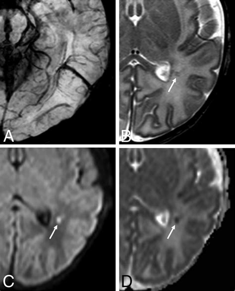 Neonatal Developmental Venous Anomalies: Clinicoradiologic ...