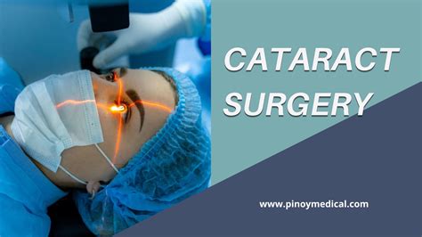 Cataract Surgery Price in the Philippines 2026 — PinoyMedical