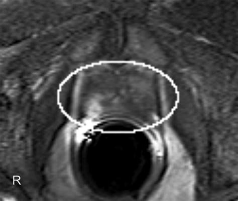 Dynamic Contrast-Enhanced MRI of Prostate Cancer at 3 T: A Study of ...