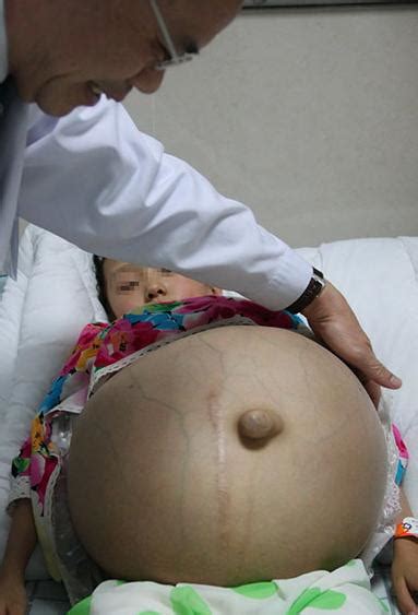 7岁女孩肚子不断膨胀，怀上畸胎瘤的她肚皮上青筋爆现情状吓人|畸胎瘤|肚皮|胎儿_新浪网