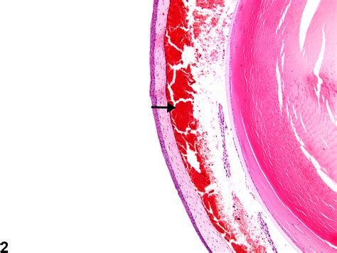 Eye, Anterior Chamber - Hemorrhage - Nonneoplastic Lesion Atlas