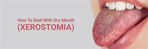Finding Relief: Effective Ways to Manage Dry Mouth
