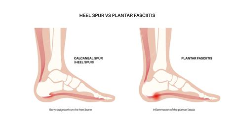 Premium Vector | Calcaneal spur and plantar fasciitis comparison Foot ...