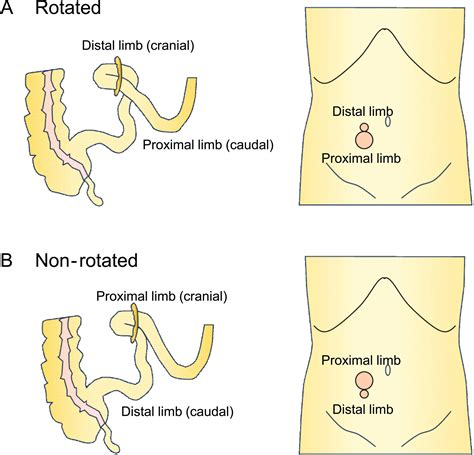 Influence of the rotation of the diverting loop ileostomy in rectal ...
