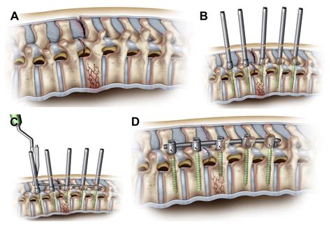 What Is Next in Computer-Assisted Spine Surgery? Advances in Image ...