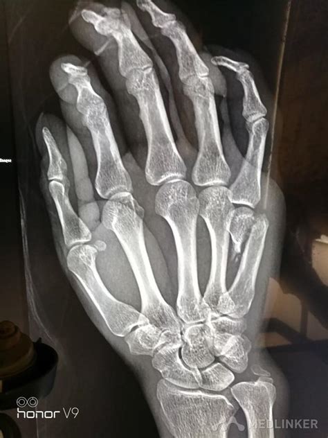 右手第五掌骨骨折-医联