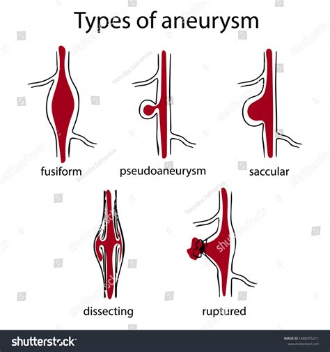Pseudoaneurysm Vs Aneurysm
