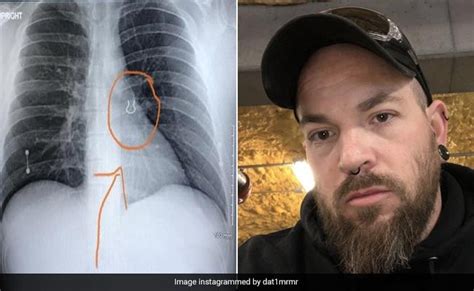 सीने में हुआ दर्द, डॉक्टर के पास गया शख्स, तो फेफड़े के अंदर मिली 5 साल ...