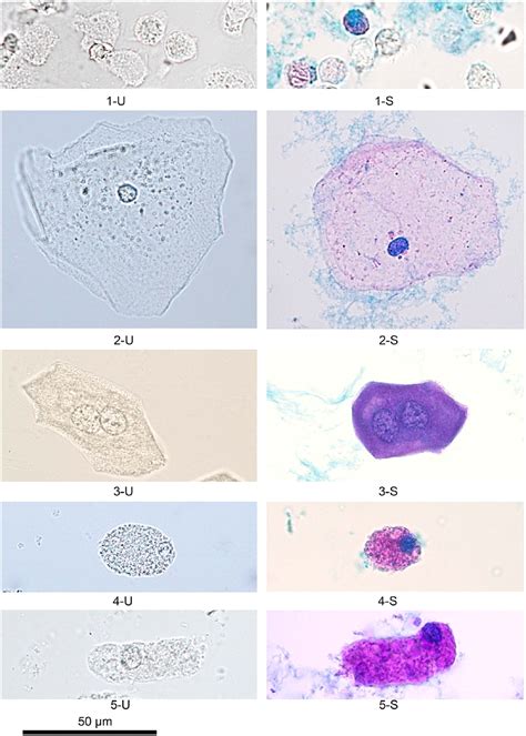Epithelial Cells In Urine