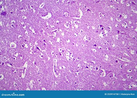 Histopathology Of Japanese Encephalitis, Light Micrograph Stock Photography | CartoonDealer.com ...