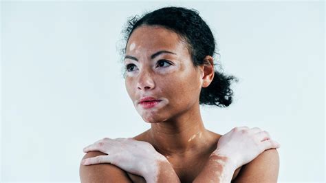 Vitiligo, la enfermedad de la piel que a pesar de ser común es muy poco conocida | El Deber