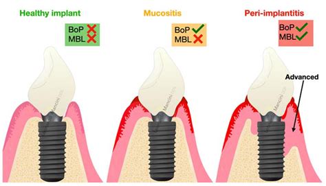 Peri-Implant Health and Diagnostic Considerations