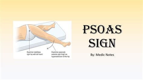 Image result for Psoas Sign